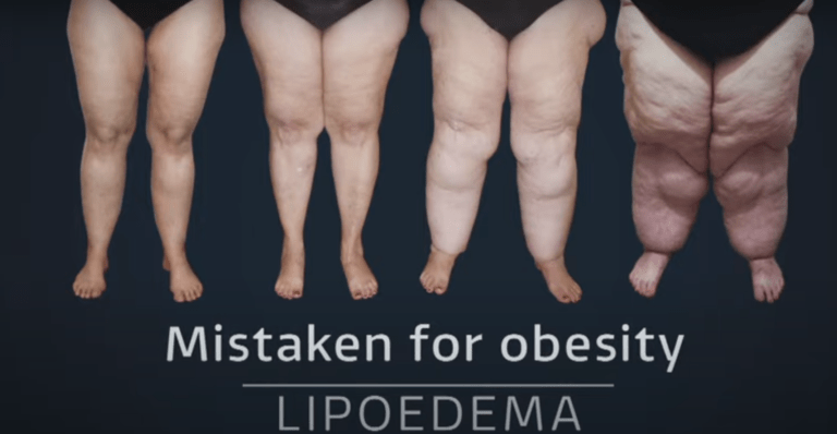 Lipedema o que é ? Lipedema Tratamento?